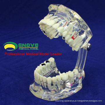 DENTAL08 (12567) Restauração de modelos de dentes de doença de implante dentário transparente